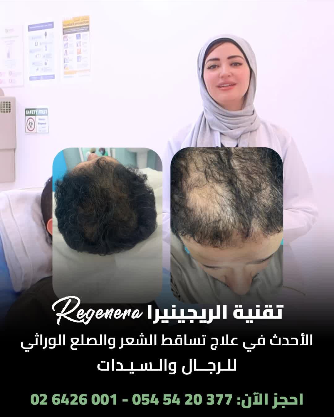 Regenera Hair Loss