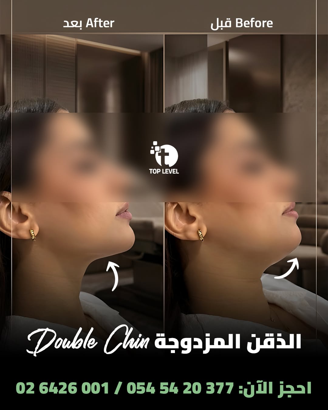 Fat Dissolving & Slimming