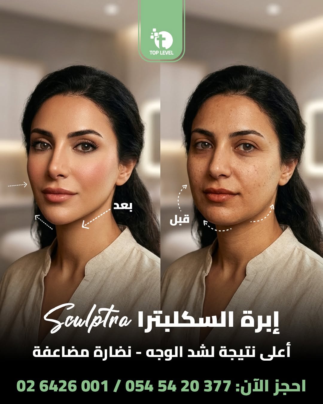 Sculptra before and after treatment